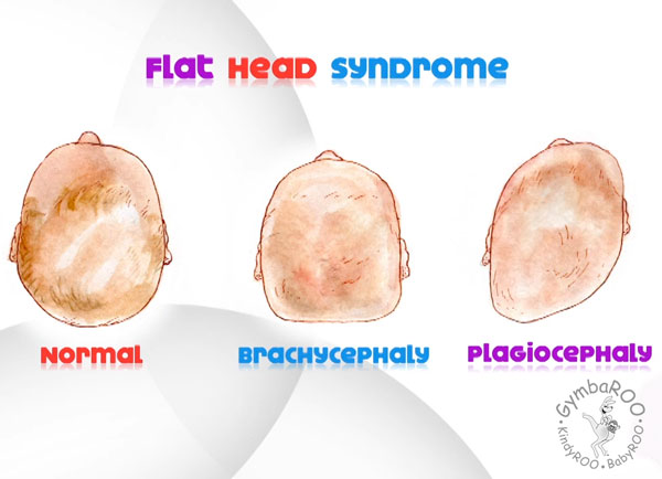 Positioning baby to prevent a flattened head shape – Plagiocephaly